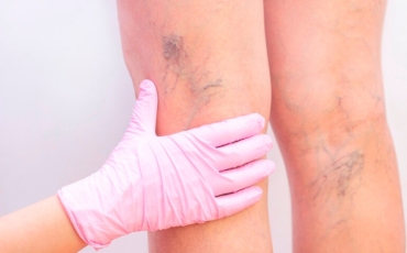 A importância do tratamento médico para veias nas pernas