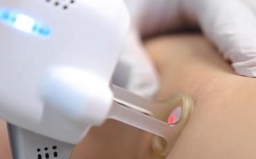 Derma V: a evolução no tratamento de vasinhos e varizes