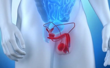 Embolização de Próstata