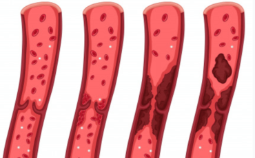 Trombose: fatores de risco e tratamento